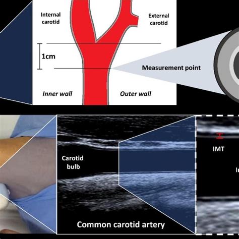 intima media thickness assessment